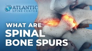 What Are Spinal Bone Spurs? | Spinal Osteophytes