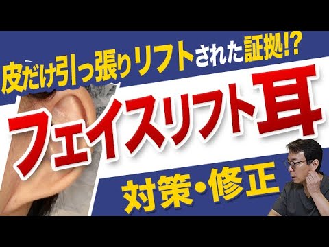 【フェイスリフト耳】耳の変形と目立つ傷跡の原因は？症例を元に耳変形させないためのポイントと傷跡の修正を解説