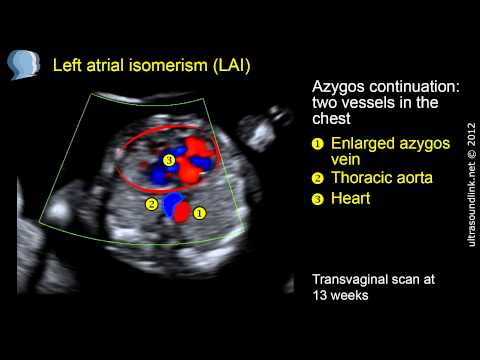 Left atrial isomerism with congenital heart block