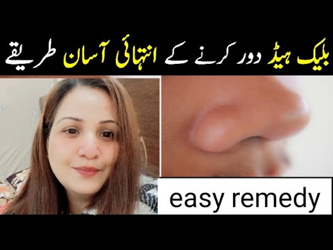 How to Get Rid of Blackheads Fast: Easy DIY Tips"