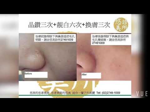 Before/after results of acne scar treatment 痘疤治療