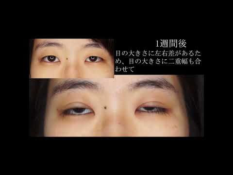 【埋没法】左右差のある目の二重手術 #shorts