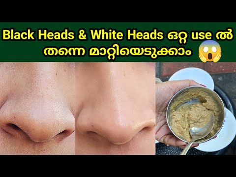 😱shocking!How to remove Blackheads/whiteheads easily at home malayalam|Blackheads Whiteheads removal