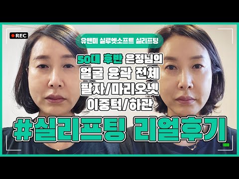 [ 리얼후기 ] 50대실리프팅 / 실루엣소프트 / 마리오넷주름 / 심부볼주름 / 팔자주름