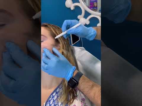 Masseter Botox for Jaw Clenching Explained by Dr. Dahabra #shorts