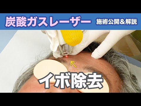 【施術動画】炭酸ガスレーザー施術を完全公開！イボを除去します！