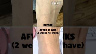 Ulike IPL Hair Removal after 11 Weeks