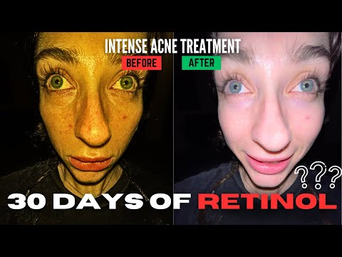 I tried TRETINOIN for 30 days... | acne treatment full documentation