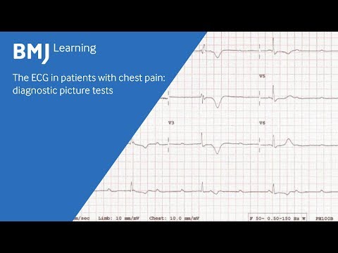 ECG in patients with chest pain: diagnostic picture test from BMJ Learning