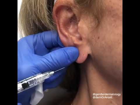 Earlobe Filler I Gendler Dermatology