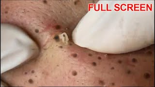 Blackheads Removal -  Best Pimple Popping Videos