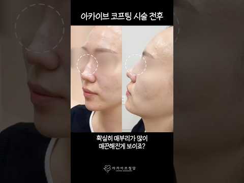 아카이브 코실리프팅 시술👃ㅣ코수술보다 빠르고 안전한 매부리코 개선법 #shorts