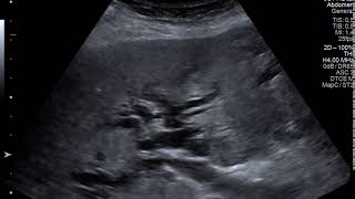 Video 1 - B mode ultrasound