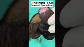 Effective Tight Foreskin Treatment with Advanced Stapler Circumcision  Rejuvena Cosmo Care