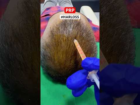 Hair PRP Treatment for Hairloss ,Hair thinning #shorts #mumbai