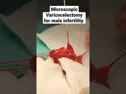 Microscopic Varicocelectomy for man infertility By Dr Araz Bayramov