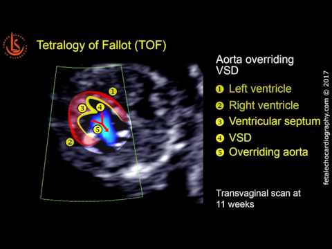 Fetal echocardiography at 11-13 weeks: Tetralogy of Fallot (TOF)