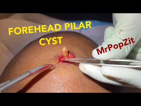 Good size Pilar cyst right in the middle of the forehead!Removal of sac and contents.2 wk follow up