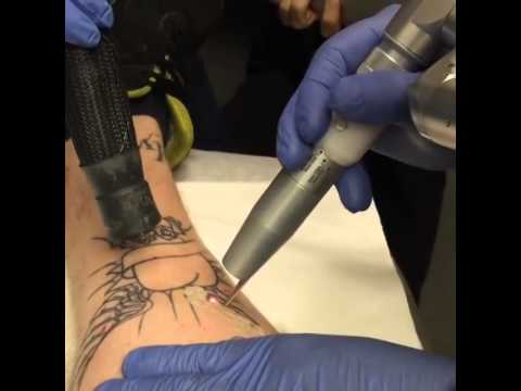 Medlite C6 Laser Tattoo removal - Reno Sparks MedSpa - Dr. Calvin Van Reken