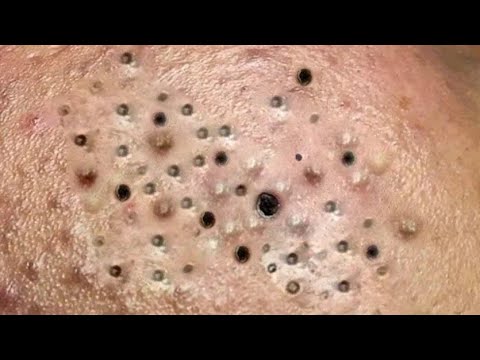 Top 5 Foods That Trigger Acne – Must Avoid!! Say Goodbye to Acne | 5 Foods You Should Never Eat!!