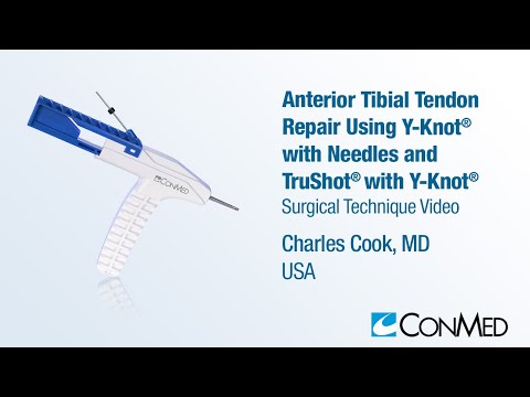 Dr. Charles Cook - Anterior Tibial Tendon Repair Using TruShot® and Y-Knot® RC w/ Needles - CONMED