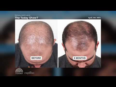 Capillus Featured  on The Today Show