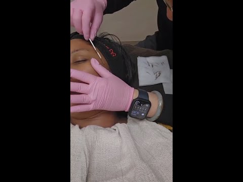 Dermaplaning Treatment