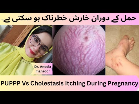 Itching during pregnancy symptoms, risk & treatment गर्भावस्था के दौरान खुजली क्यों होती है?