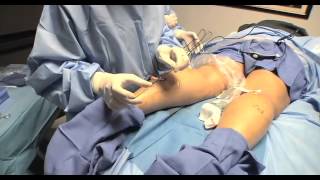 Varicose Vein Ablation | UCLA Vital Signs