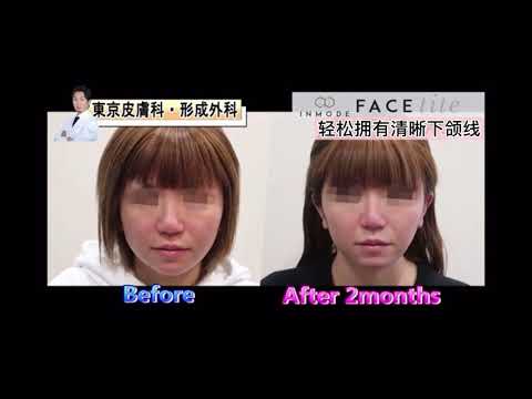 日本资深医美翻译贾贾vlog 最新塑造面部轮廓的微整形-Face Tite