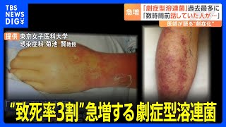 “致死率3割”急増する劇症型溶連菌 「数時間前まで話していた患者が…」救急医が進行の速さ語る　今年の患者数977人で既に去年1年間を上回る｜TBS NEWS DIG