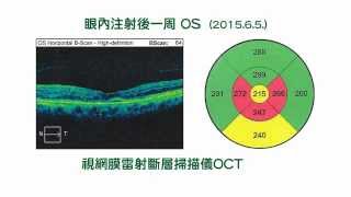 黃斑部病變以Eylea (aflibercept)眼內注射治療(Intravitreal Injection IVI)治療 2015.07.07 蕭裕泉醫師 新眼光眼科診所 蕭裕泉醫師