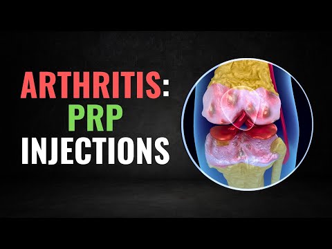 Why PRP Is The Best Knee Injection For Osteoarthritis