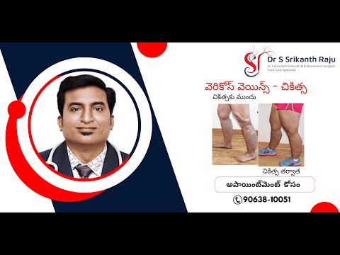 వెరికోస్ వెయిన్స్ - చికిత్స | డా.శ్రీకాంత్ రాజు | వాస్కులర్ సర్జన్ | హైదరాబాద్