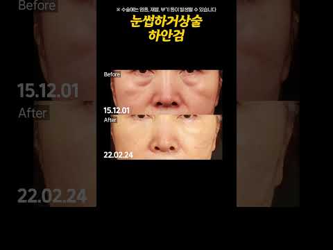 불룩한 눈 밑 살! 로렌의 눈썹하거상술과과 하안검 수술 #shorts