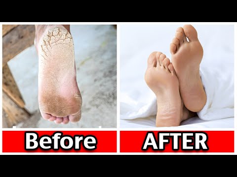 10 Ways To ELIMINATE Dry Cracked Feet And Heels!