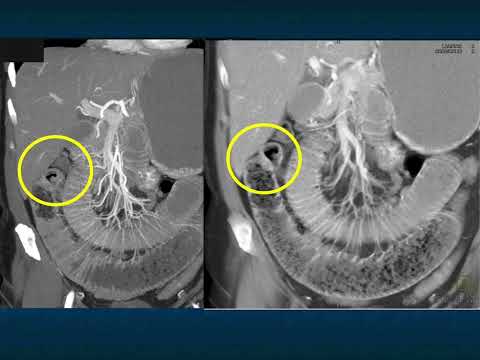 CT Evaluation of Suspected SBO: State of the Art 2024 - Part 2