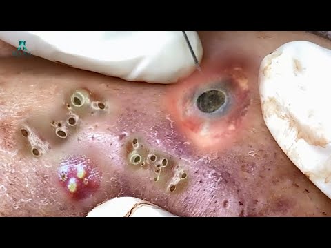 Remove Blackheads and Pimples Popping