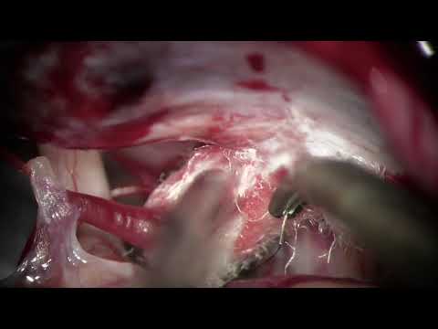 Microvascular transposition using Teflon sling technique