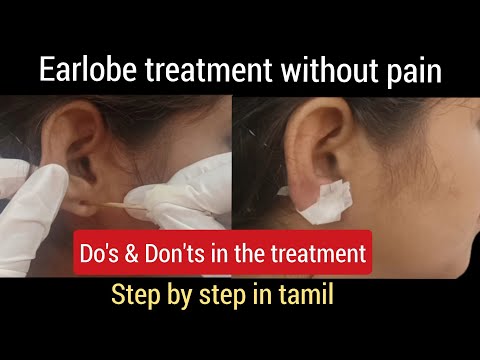 Earlobe surgery without pain 👂// earlobe surgery//earlobe treatment in parlour