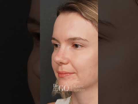 Rhinoplasty Transformation by Assoc. Prof. Dr. Güncel Öztürk | Before & After Results