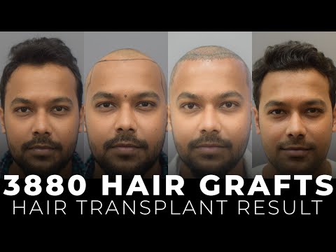 Shocking Before & After Hair Restoration | Trichometric Sapphire FUE | Cara Clinic