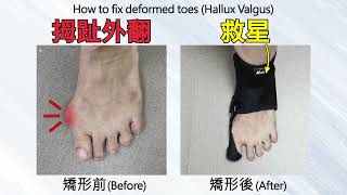 拇趾外翻救星 | How to fix deformed toes (Hallux Valgus) | F04b