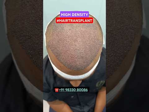 #hairtransplant #hair #hairloss #besthairtransplant #drpranilmore #ytshorts #shorts #highdensity