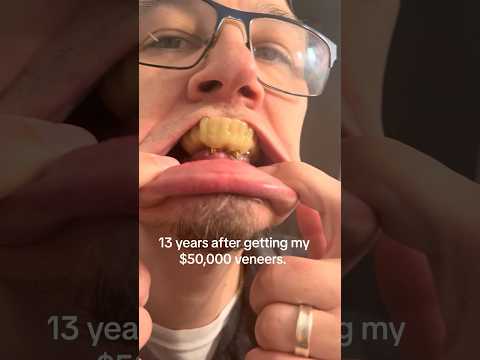 He Spent $50,000 On His Teeth And THIS Happened! 😳🦷