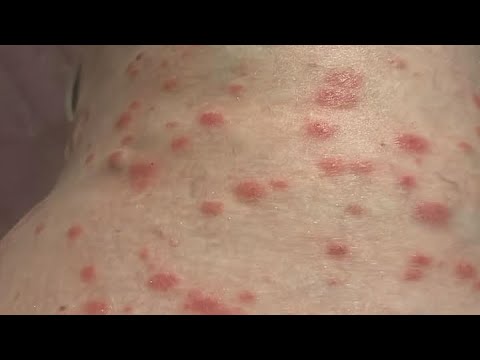 Eczema and psoriasis treatment using plant medicine