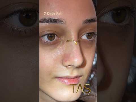 #drsuleymantas #rhinoplasty #profdrsuleymantas #nosejob #beauty #transformation