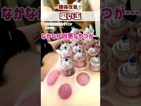 【吸い玉】吸い玉で腰痛改善！