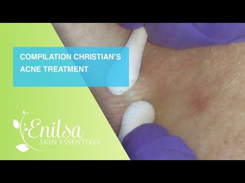 Compilation of Christian’s Acne Treatment