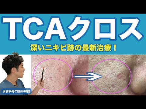 【ニキビ跡の最新治療】TCAクロスとは！？